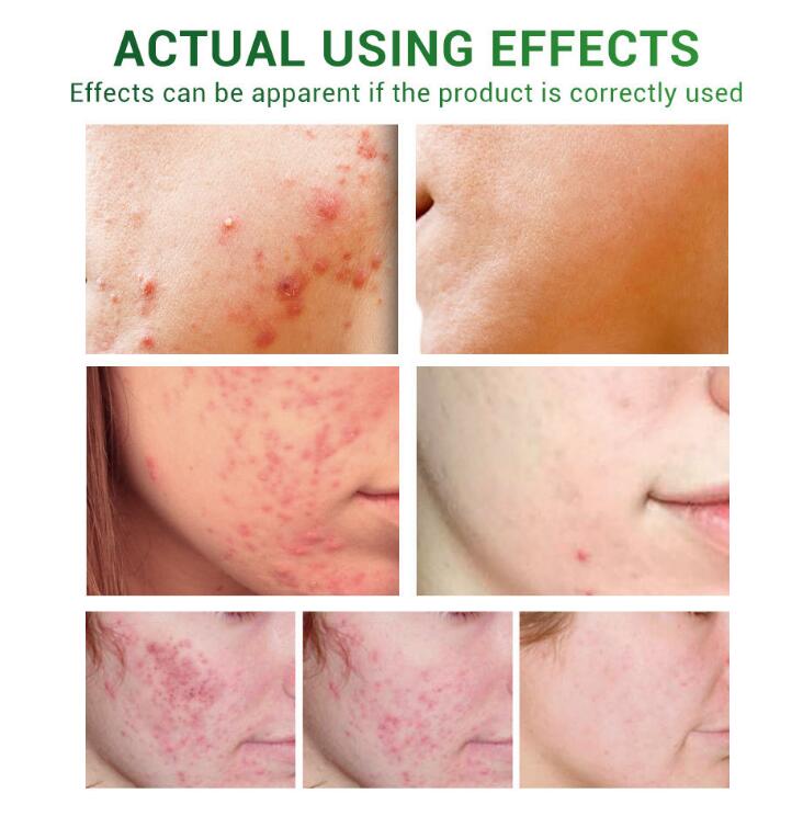 Acne Treatment Serum Facial Repair Oil - Body Bliss Essentials