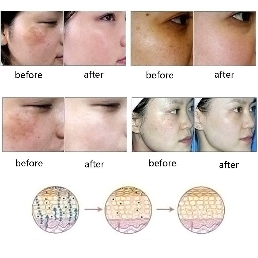 Dredge Meridian Skin Care Natural Pure Removal Acne Stretch Marks Scar Removal Essence oil - Body Bliss Essentials