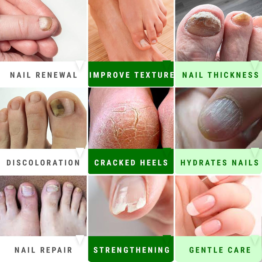 Urea Nail Gel - Softens Cracked Heel Calluses & Thick Toenails - Body Bliss Essentials